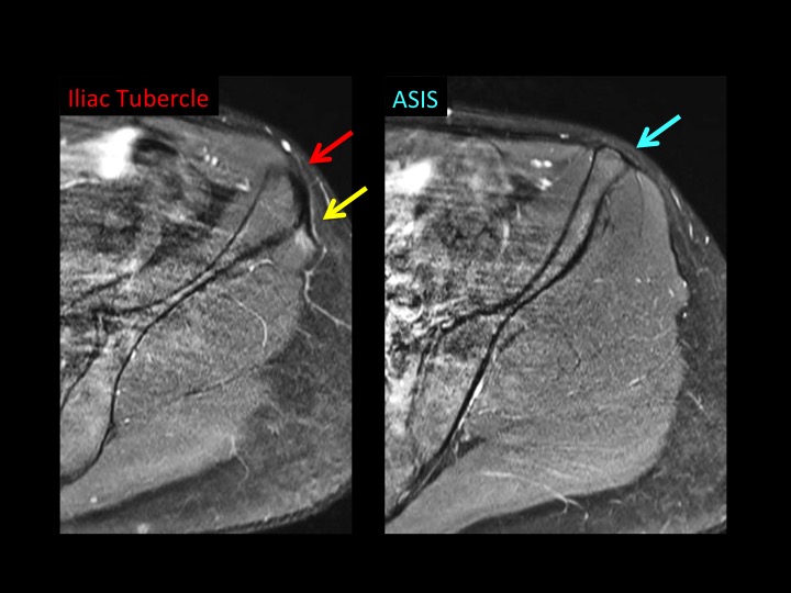 Figure 2 for case iliotibial band ( RID2855 )